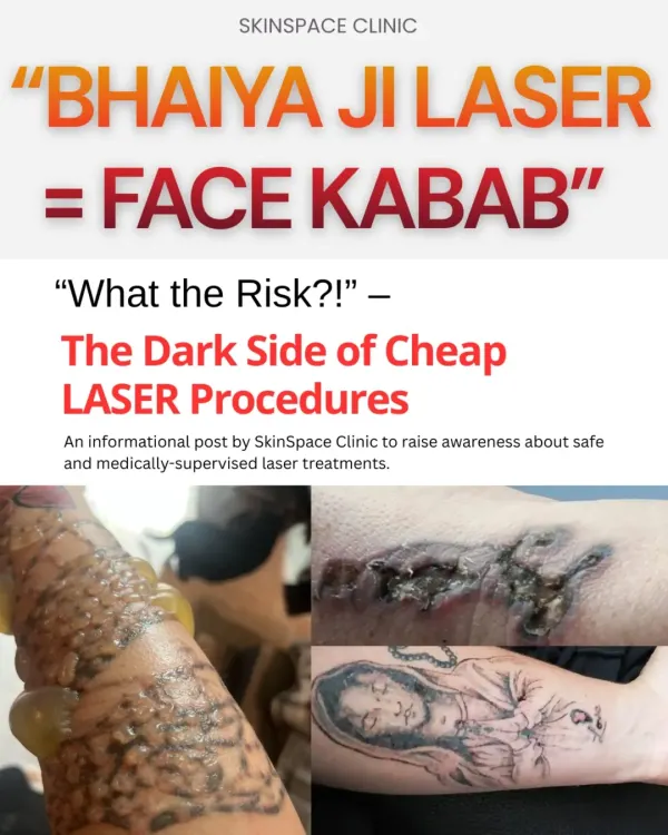 The phrase "Bhaiya Ji Laser = Face Kabab" might sound funny, but the reality is terrifying. This image shows the dark side of cheap laser procedures, including severe blistering and burns from tattoo removal attempts by untrained operators.