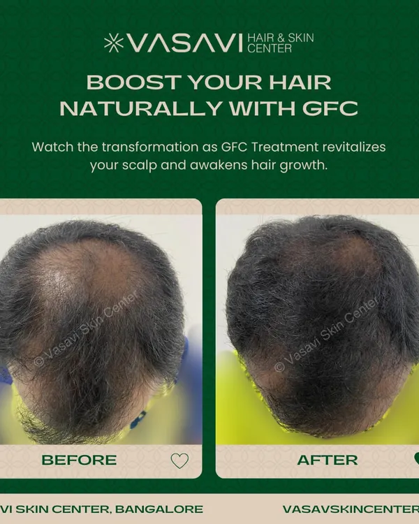 This before and after comparison shows a significant increase in hair density for a patient after completing a course of GFC treatments. The therapy naturally revitalized the scalp and awakened dormant hair follicles for substantial regrowth.