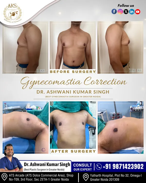 A comprehensive before and after view of a gynecomastia correction. The images clearly show the reduction of breast tissue and improved chest shape from multiple angles, resulting in a more traditionally masculine physique.