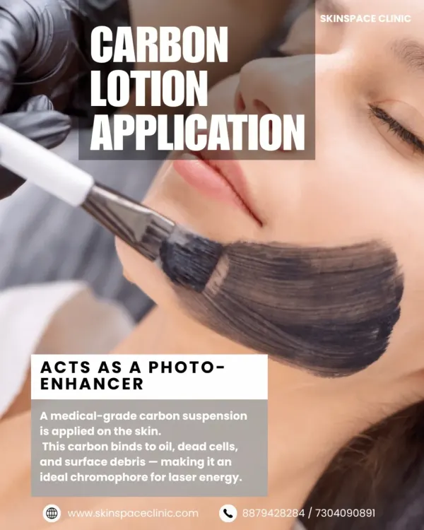 The first step of the Hollywood Carbon Peel is the application of a medical-grade carbon lotion. This lotion acts as a photo-enhancer, binding to oil and surface debris to prepare the skin for the laser.