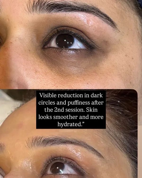 A close-up look at the reduction in dark circles and puffiness after just two sessions. The skin under the eye is visibly smoother, brighter, and more hydrated, showcasing the effectiveness of my targeted eye treatment.