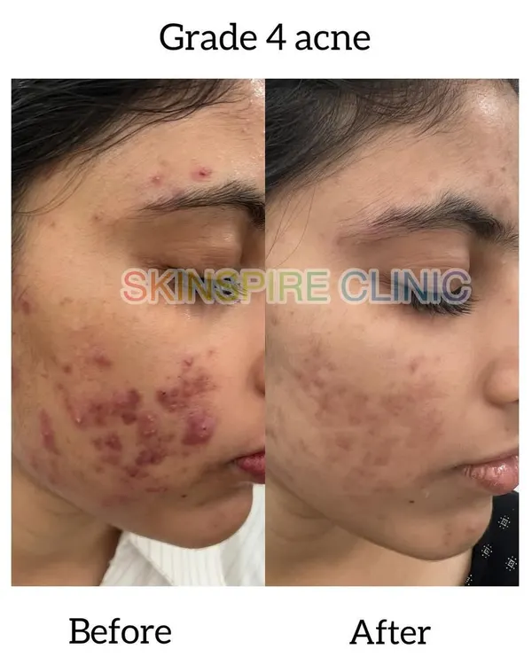 This before and after shows the significant progress made in treating severe Grade 4 cystic acne. Our approach focuses first on calming the active breakouts and inflammation, then moving on to address the resulting marks and scars for clearer, healthier skin.
