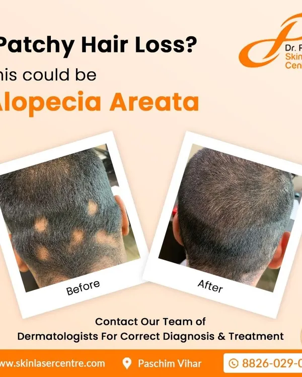 I find that showing results is often the most reassuring step for my patients. Here you can see a clear before and after of a patient treated for Alopecia Areata, or patchy hair loss, showing significant hair regrowth and coverage after treatment at our clinic.