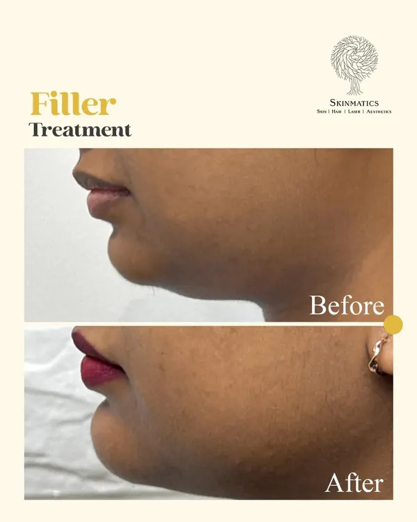 This before-and-after shows how a dermal filler treatment can create a more defined chin and balanced lower face profile. This is a non-surgical approach to enhance facial harmony with instant, natural-looking results.
