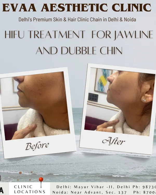 A clear before-and-after view of our HIFU treatment for jawline contouring and double chin reduction. This non-surgical procedure tightens skin and defines the facial profile with no downtime.