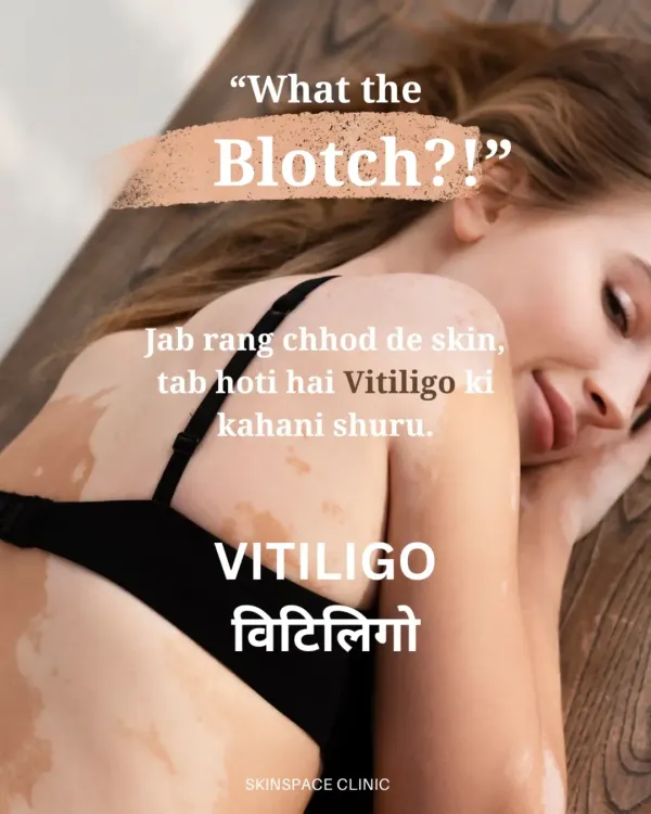 This graphic introduces vitiligo, a condition where the skin begins to lose its color, creating white patches. We believe in spreading awareness and providing supportive care for those affected.