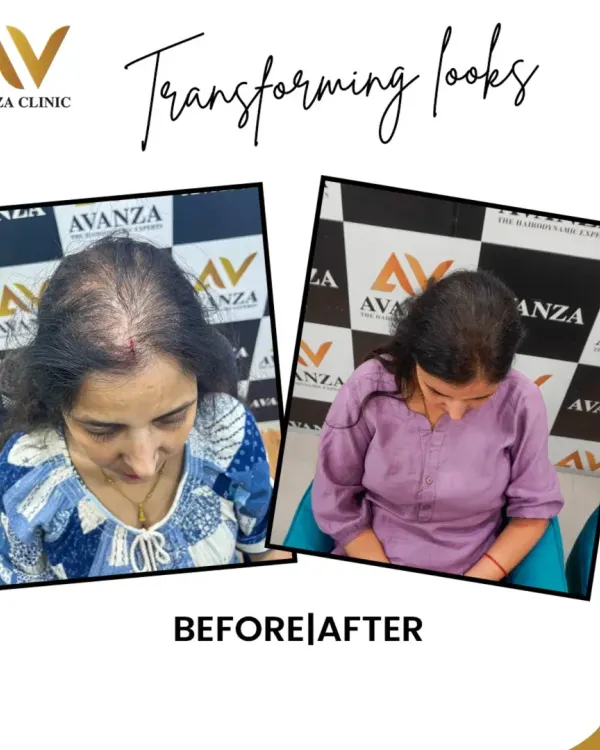 This before and after collage shows a significant improvement in hair density for one of our female clients, restoring fullness and confidence.