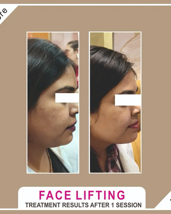 A clear view of the power of High-Intensity Focused Ultrasound (HIFU). This non-surgical facelift treatment effectively tightens the skin and contours the jawline, providing a noticeable lift after just one session.
