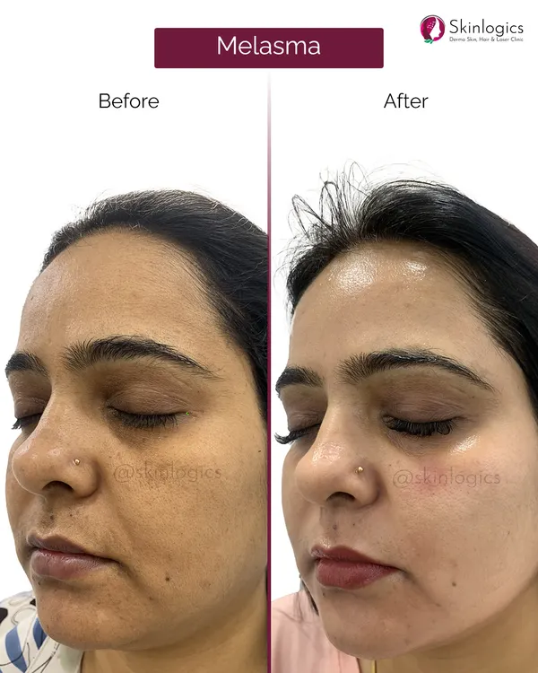 This image shows the significant reduction of melasma on a patient's face. The 'before' photo on the left displays prominent dark patches on the cheeks and forehead, while the 'after' photo on the right reveals a much clearer, brighter, and more even-toned complexion, demonstrating the effectiveness of our customized treatment plans.