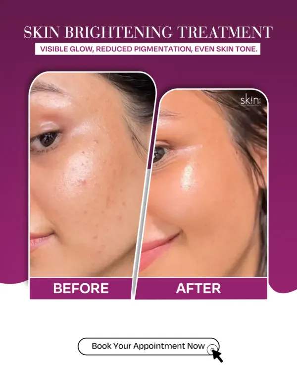 This before-and-after shot shows the real impact of my skin brightening treatments. I focus on reducing pigmentation and correcting uneven skin tone to reveal a naturally radiant and clear complexion.