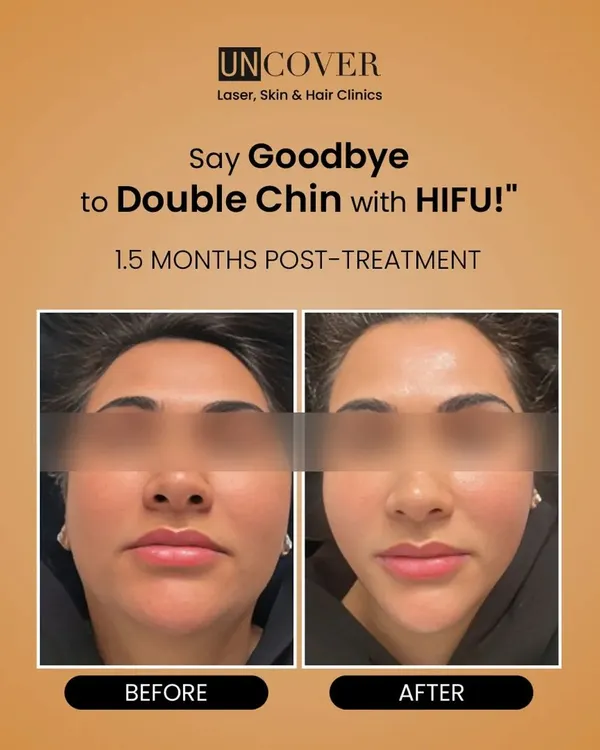 This before-and-after photo shows the power of HIFU to redefine the jawline by treating a double chin. The result is a visibly slimmer and more sculpted facial profile.