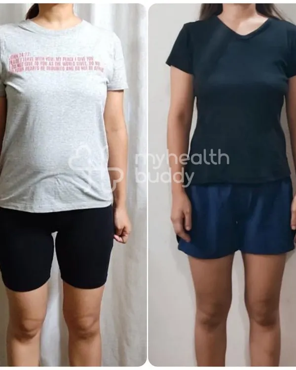 This is a powerful Diastasis Recti transformation. With targeted exercises, we were able to significantly close the abdominal separation and rebuild core function.