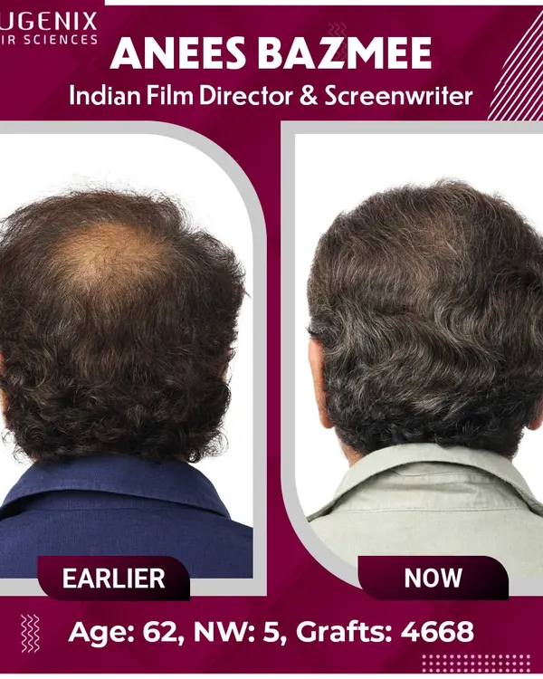 A complete view of Director Anees Bazmee's transformation from all angles, showing the density and natural hairline we created.