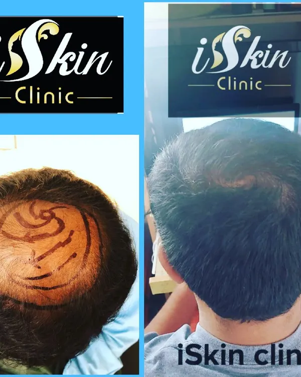 A before and after view of a successful FUE hair transplant procedure. The left image shows the scalp pre-procedure, with the treatment area for hair restoration clearly marked. The right image displays the final result, showcasing significant hair regrowth and excellent density for a natural look.