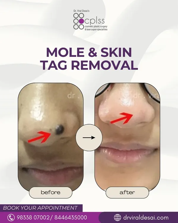 This before and after image shows the precise and effective removal of a mole from the side of the nose. The procedure results in clear, smooth skin with no visible scarring, restoring the natural contour of the face.