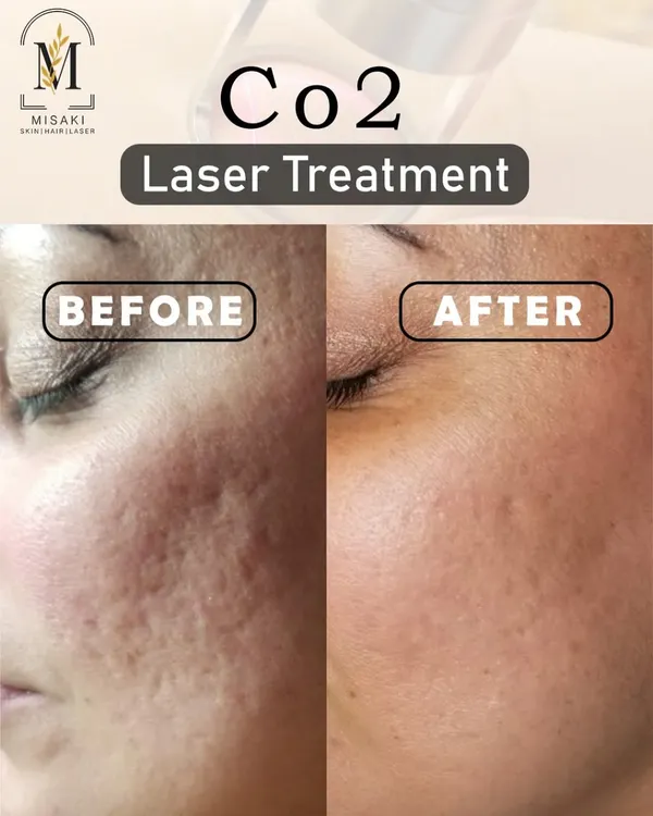 This is the power of a doctor-led, advanced skin treatment. Here you can see a significant reduction in deep acne scars and improved skin texture after a personalized CO2 laser resurfacing plan. We achieve real, visible results safely.