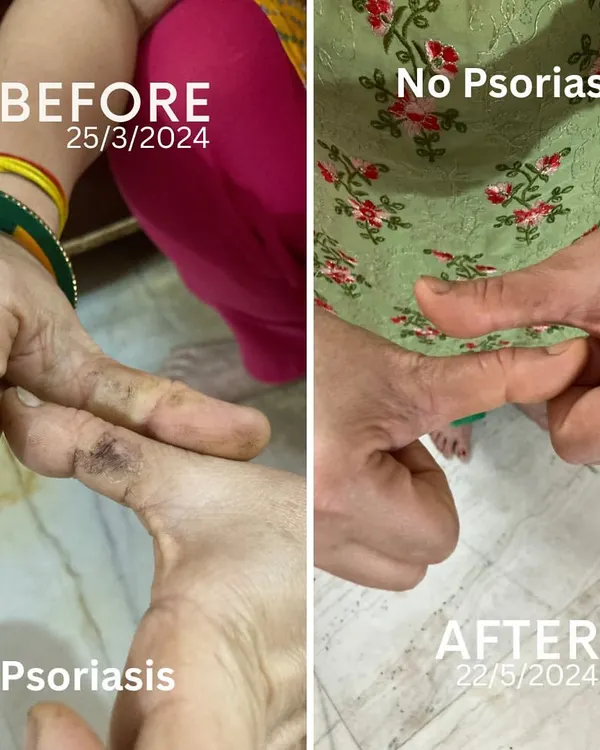 This is a two-month transformation of my mother's Psoriasis, a condition doctors called incurable. The 'before' image shows the inflammation on her finger, and the 'after' shows her skin completely healed through a dedicated Yogic and Ayurvedic regimen.