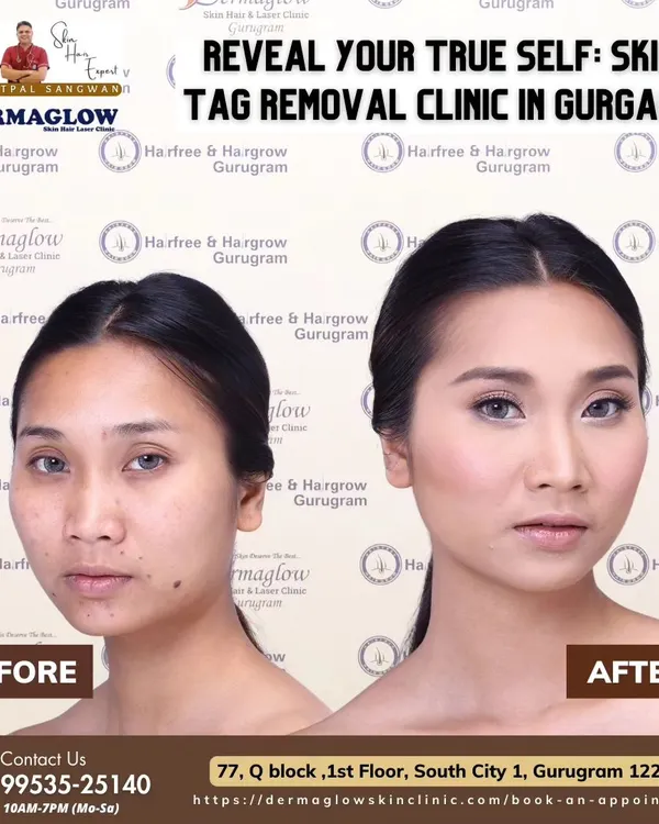 This is the transformative power of our radiofrequency treatment. We helped this client achieve clear, smooth skin by precisely removing numerous facial skin tags, restoring not just their appearance but also their confidence.