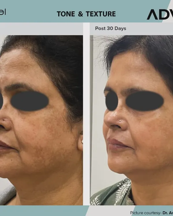 This is the result of a personalized AdvaTx laser plan to correct years of sun damage and uneven skin tone. Notice the significant reduction in pigmentation and the overall improvement in skin texture and brightness after just 30 days.