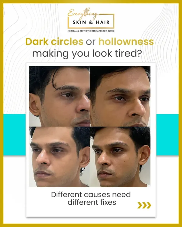 A clear before-and-after of under-eye treatment on a male patient. Addressing the tear trough hollows not only reduces the appearance of dark circles but also restores a more alert and refreshed look, proving that this treatment is effective for everyone.