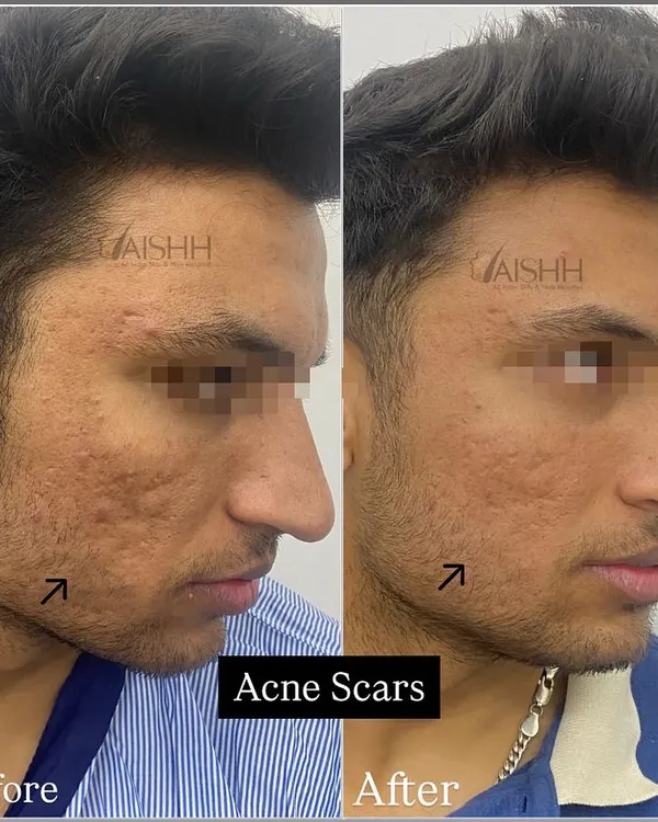 This before-and-after shows the significant improvement possible for deep acne scars. We used a combination of subcision to break up the scar tissue, lasers to resurface the skin, and a fat transplant to restore lost volume, achieving a much smoother texture after just three sessions.