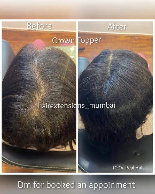 A perfect example of a crown topper transformation. This before and after shows how our toppers provide excellent coverage for thinning hair on the crown, blending seamlessly.
