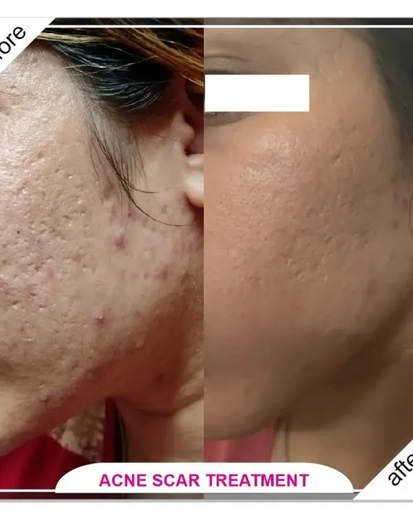 A remarkable improvement in deep, pitted acne scars after a customized treatment plan. We used a combination of CO2 laser and MNRF to remodel the skin's surface.