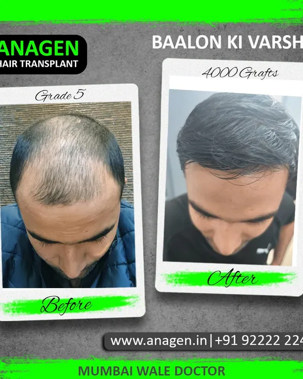 We call this result "Baalon ki Varsha" or a shower of hair. This patient received 4000 grafts to address Grade 5 baldness, resulting in a full, dense head of hair that completely transformed his appearance.