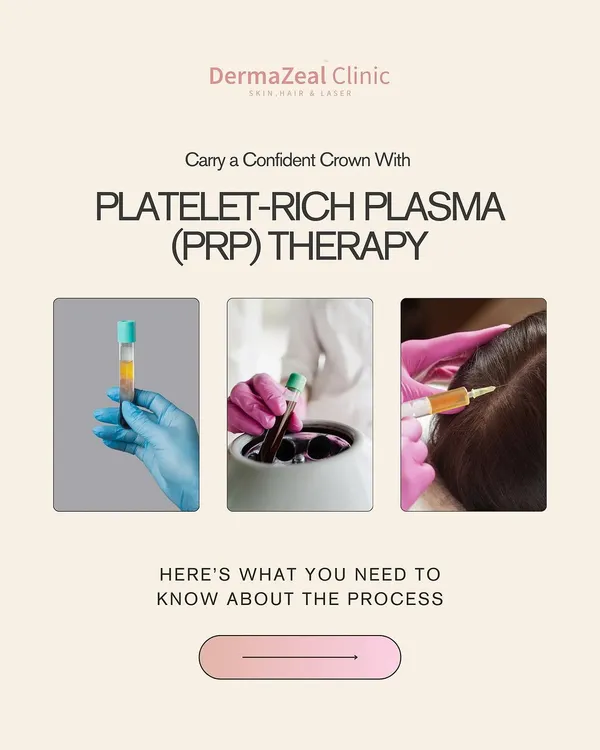This graphic provides a clear overview of the Platelet-Rich Plasma (PRP) therapy process. It is a three-step medical treatment where a person's blood is drawn, processed, and then injected into the scalp to encourage new hair growth.