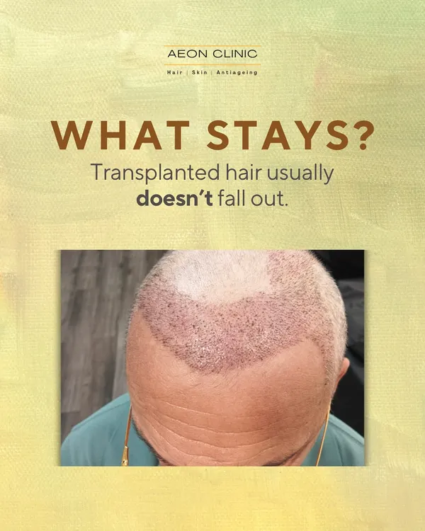 A common question is: does transplanted hair fall out? The hair from the donor area is permanent and typically does not fall out.