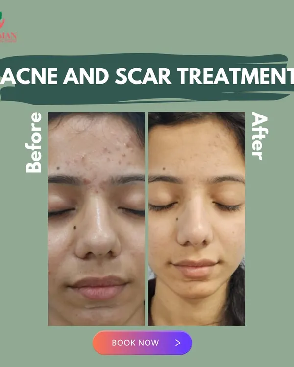 This powerful before-and-after transformation shows the results of our personalized acne and scar treatment. We effectively reduced inflammation, cleared breakouts, and significantly faded post-acne marks, revealing smoother, clearer skin.