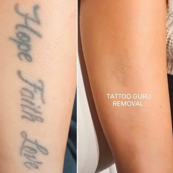 A full forearm piece with the words 'Hope Faith Love' completely removed. This shows how even longer text tattoos can be cleared effectively over multiple sessions.