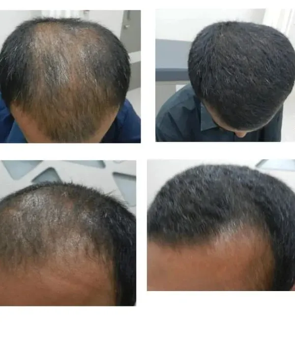 This is a powerful example of what is possible with a proper diagnosis and personalized medical plan. This client saw significant hair regrowth in just three months through medical management alone, with no transplant or PRP injections needed. It shows that addressing the root cause is key to treating hair thinning.