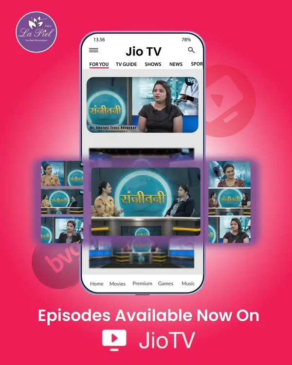 I was pleased to share my expertise on several key skin and hair topics for the Sanjeevani program, now available on JioTV. You can watch episodes where I discuss solutions for pigmentation, acne, psoriasis, and offer tips for achieving healthy hair and glowing skin.