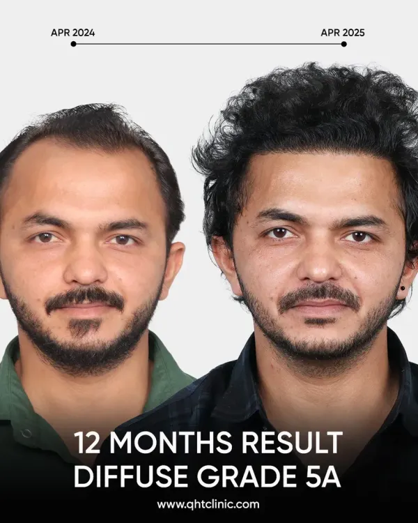 This is the power of a single year. We took this patient from Diffuse Grade 5A baldness to a full, natural head of hair with 3600 grafts. This isn't just about hair, it's about getting your confidence back.