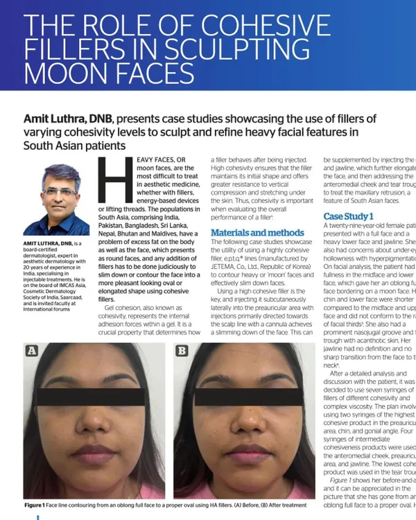A look at my latest article in Prime Journal on the role of cohesive fillers in sculpting "moon faces" in South Asian patients, showcasing a before-and-after case study.
