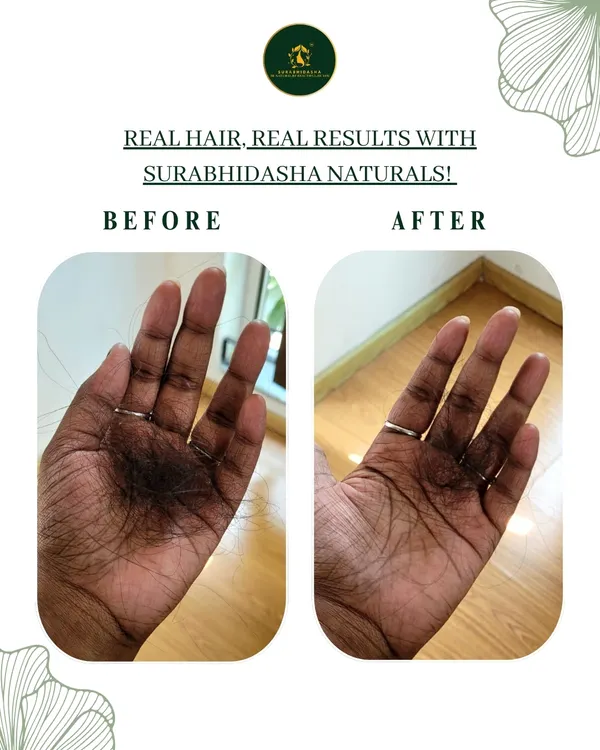 This is why I started Surabhidasha. This image shows the real, visible reduction in hair fall a client experienced after using my Protein Shampoo and Hibiscus Glow Conditioner. It’s not about magic, it’s about giving your hair the right natural nourishment.