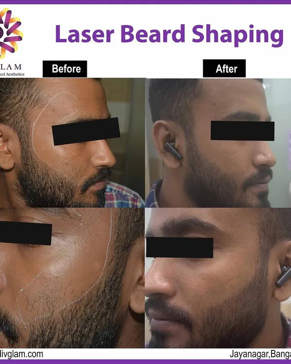 Here is a clear before and after look at our laser beard shaping service. We used precise, FDA-approved laser technology to create a defined, clean cheek line, permanently removing unwanted hair above the main beard area. This result eliminates the need for daily shaving and prevents common skin irritation.