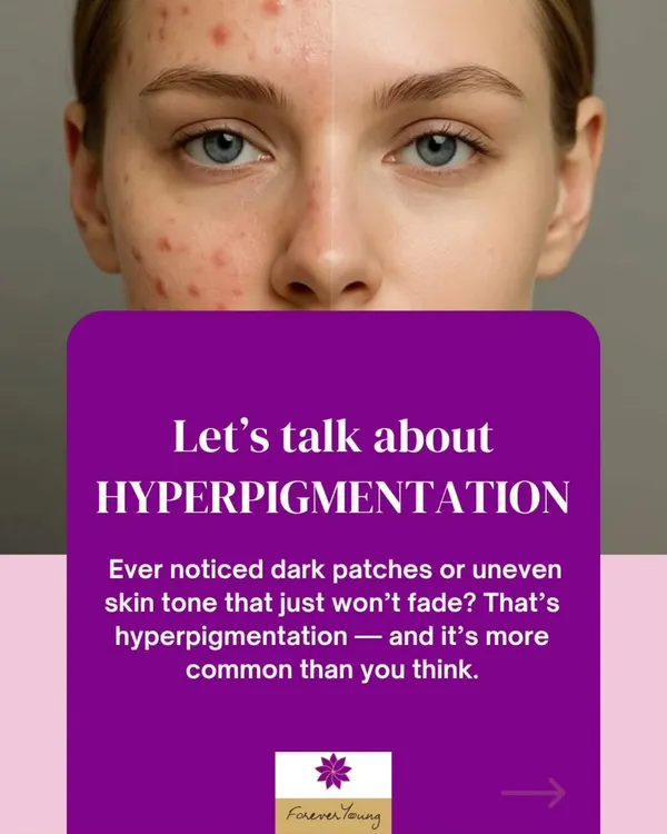 If you have noticed dark patches or an uneven skin tone that will not fade, you may be dealing with hyperpigmentation. This is a very common condition where the skin overproduces melanin in certain spots.