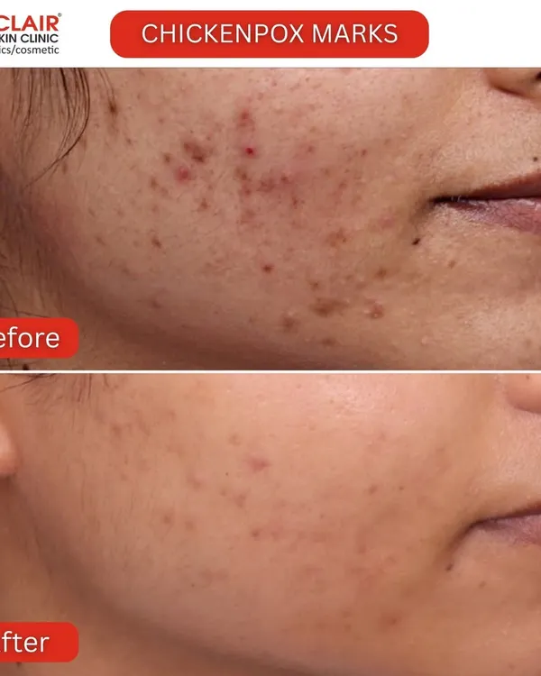 Stubborn chickenpox marks from childhood don't have to be permanent. This before and after shows a significant fading of pigmented marks and a smoothing of atrophic scars for much clearer skin.
