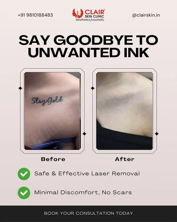 A clear example of our work. This client's collarbone tattoo was completely removed over several sessions, leaving no trace of the original ink. Our laser tattoo removal process is tailored to your skin for safe and complete results.