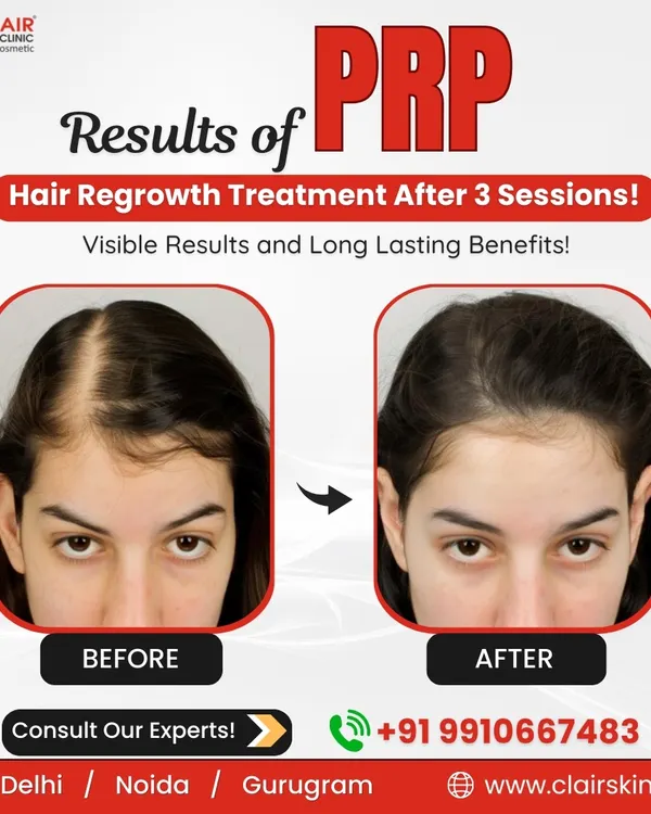 This before and after comparison shows the visible increase in hair density and scalp coverage for a client after just three sessions of our PRP hair regrowth treatment. The result is thicker, healthier hair and a significant reduction in visible thinning.