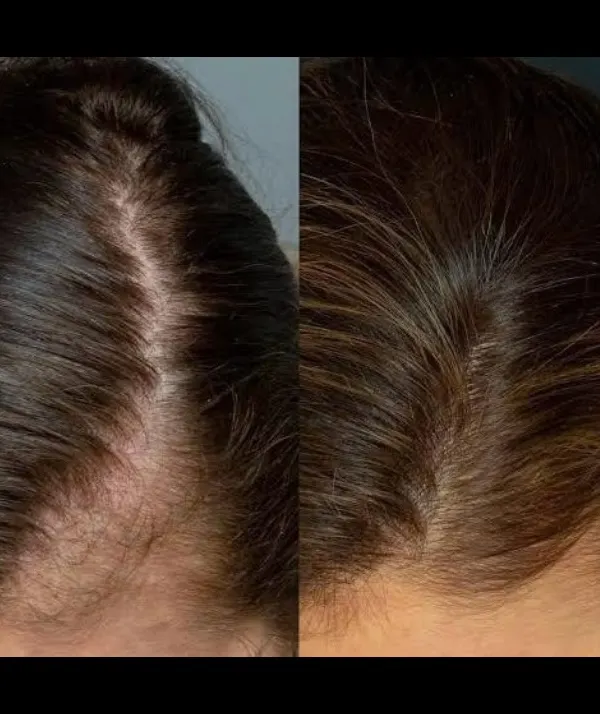The results speak for themselves. This before-and-after image shows the significant increase in hair volume and scalp coverage a client achieved with a consistent PRP treatment plan. This therapy effectively thickens hair and reduces the appearance of thinning.