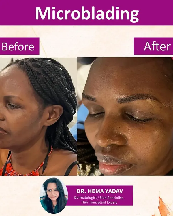 This is a great example of hyper-realistic microblading. I created fine, hair-like strokes to give these brows a fuller, more defined shape that looks completely natural and saves you time every morning.