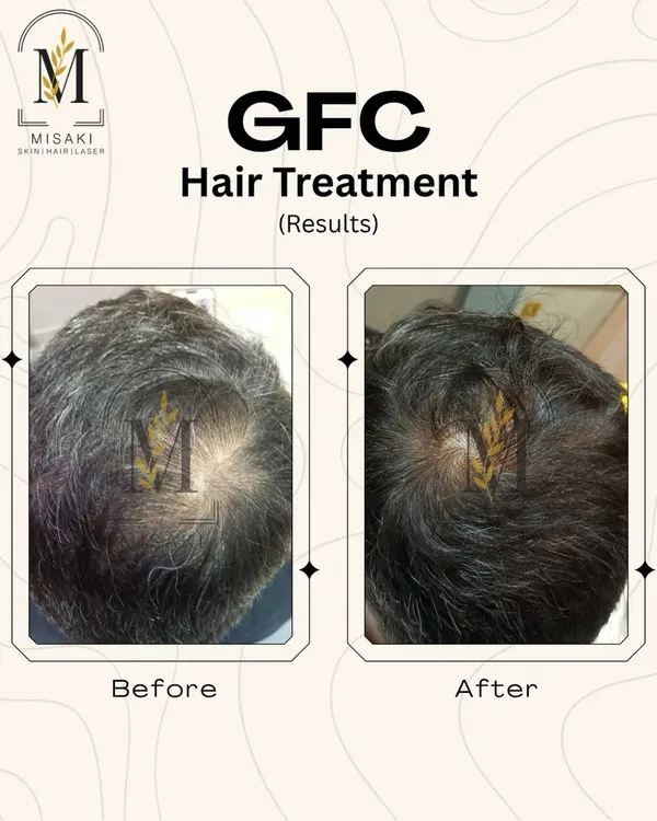 A clear example of successful GFC hair treatment. You can see the significant improvement in hair density on the crown area, a common site for male pattern baldness.