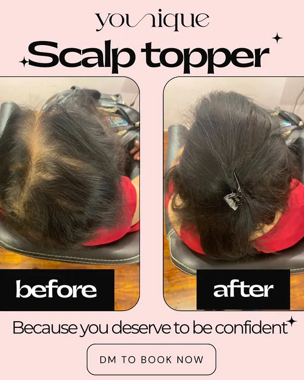A picture is worth a thousand words. This before and after shows the immediate and powerful impact of a scalp topper, instantly concealing hair thinning and restoring fullness to the crown.