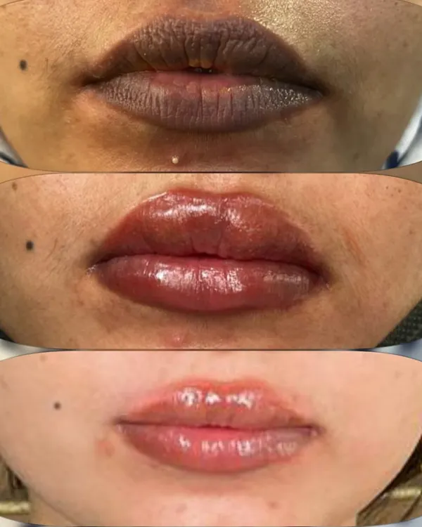This three-part image shows the complete lip blush journey over two sittings. We started with dark, pigmented lips and achieved a beautiful, soft pink shade that looks completely natural and healthy.