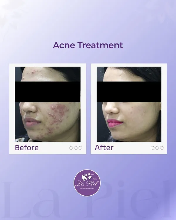 This before-and-after image showcases the journey from inflamed, persistent acne to clear, calm skin. Our treatment plans are designed to reduce irritation, clear breakouts, and restore the skin's natural health and balance.