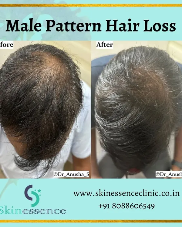 This patient was concerned about significant thinning on the crown, a common sign of male pattern hair loss. With a consistent, medically supervised routine, we were able to achieve this significant increase in hair density and coverage in just a few months, restoring his confidence.