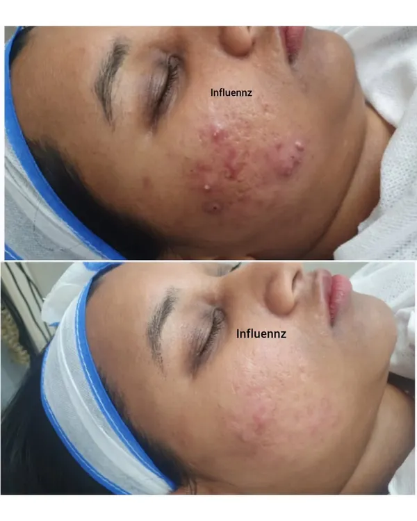 This is more than just a before and after photo; it's proof that healing is possible. If you have ever felt hopeless about your skin, I want you to know that with a personalized, scientific approach, we can achieve clear skin and restore the confidence you deserve.